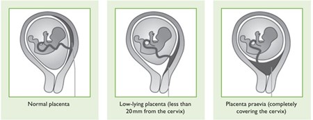 Placenta Accreta Spectrum PAS North Bristol NHS Trust